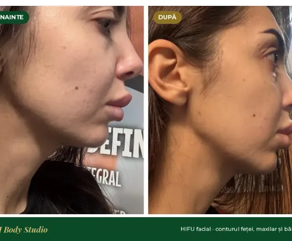 HIFU facial – BH Body Studio Militari