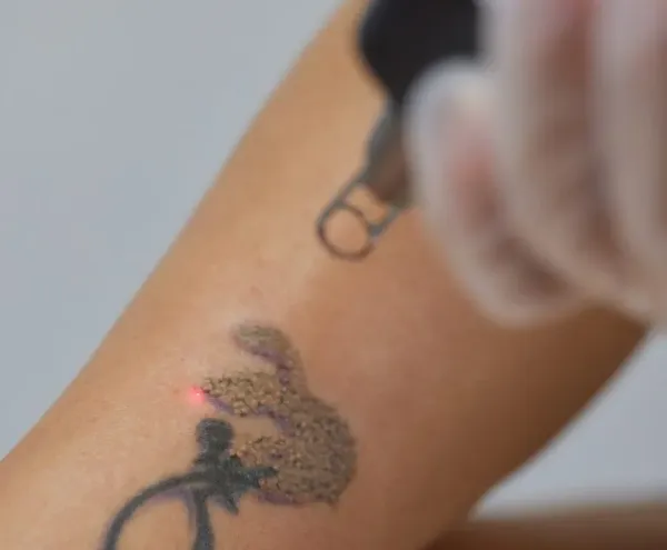 Carbon peeling și ștergere tatuaje – BH Body Studio Militari