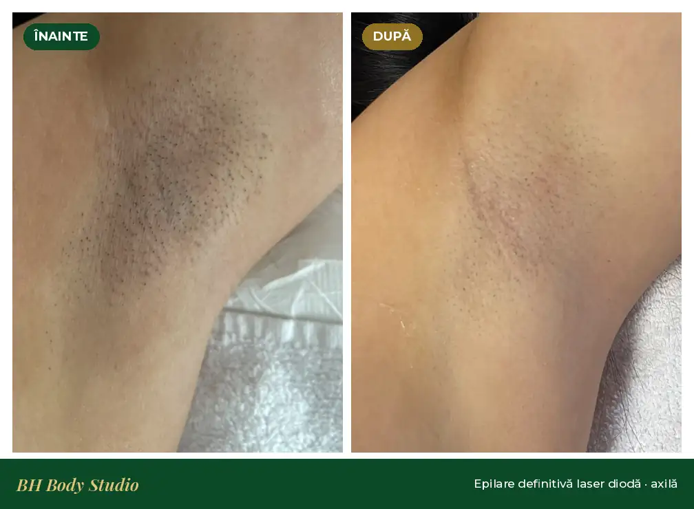 După tratament – BH Body Studio Militari